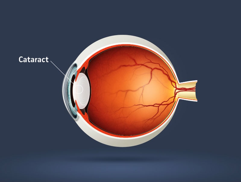 What Causes Cataracts?