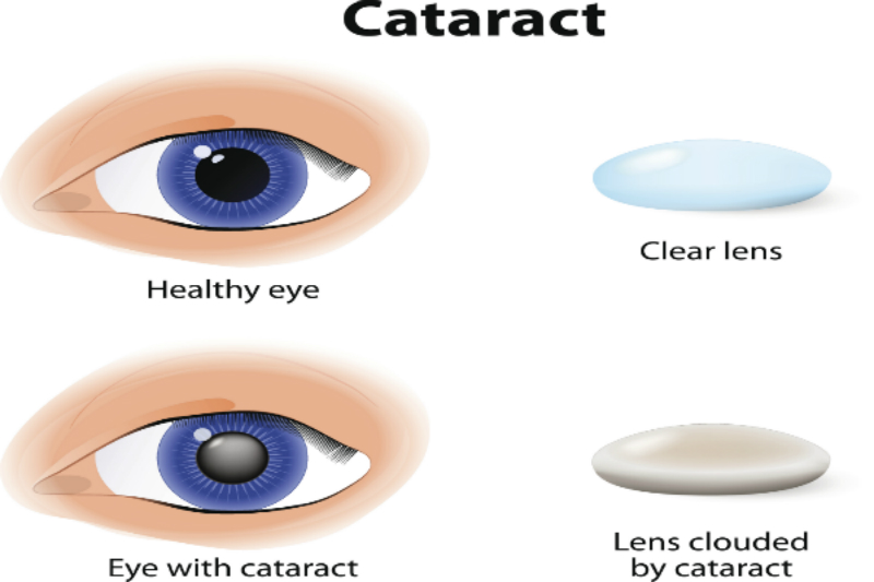 Cataract Surgery Rowan Eye Center
